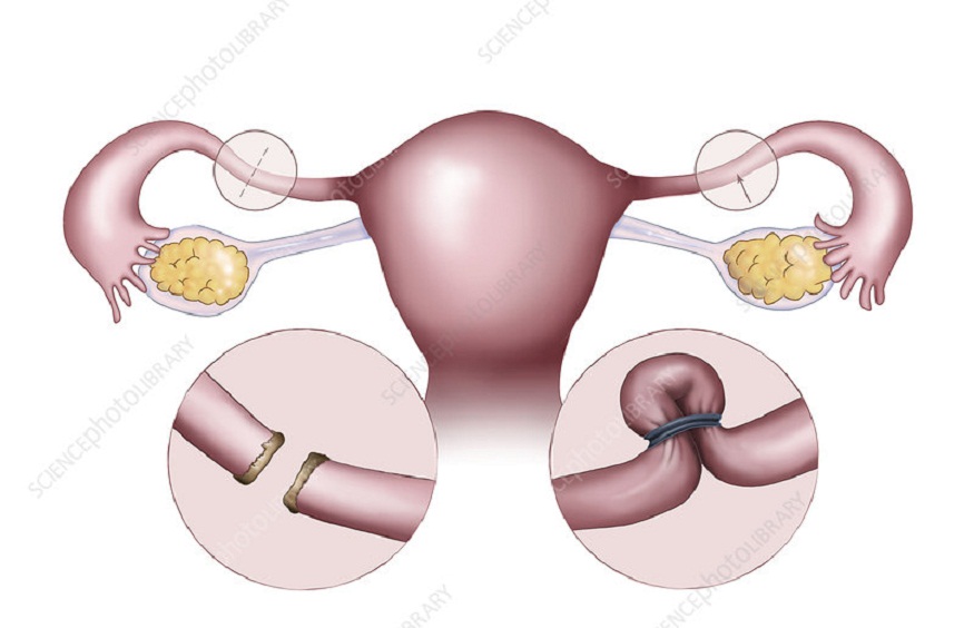 Understanding the Types of Tubectomy